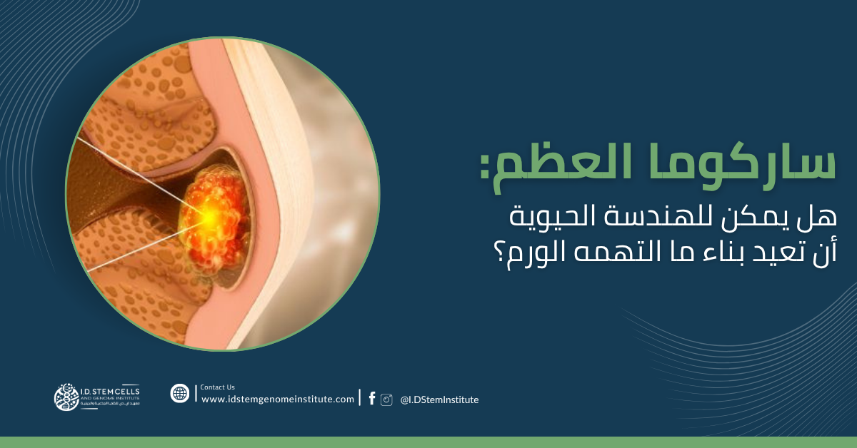  ساركوما العظم: هل يمكن للهندسة الحيوية أن تعيد بناء ما التهمه الورم؟
